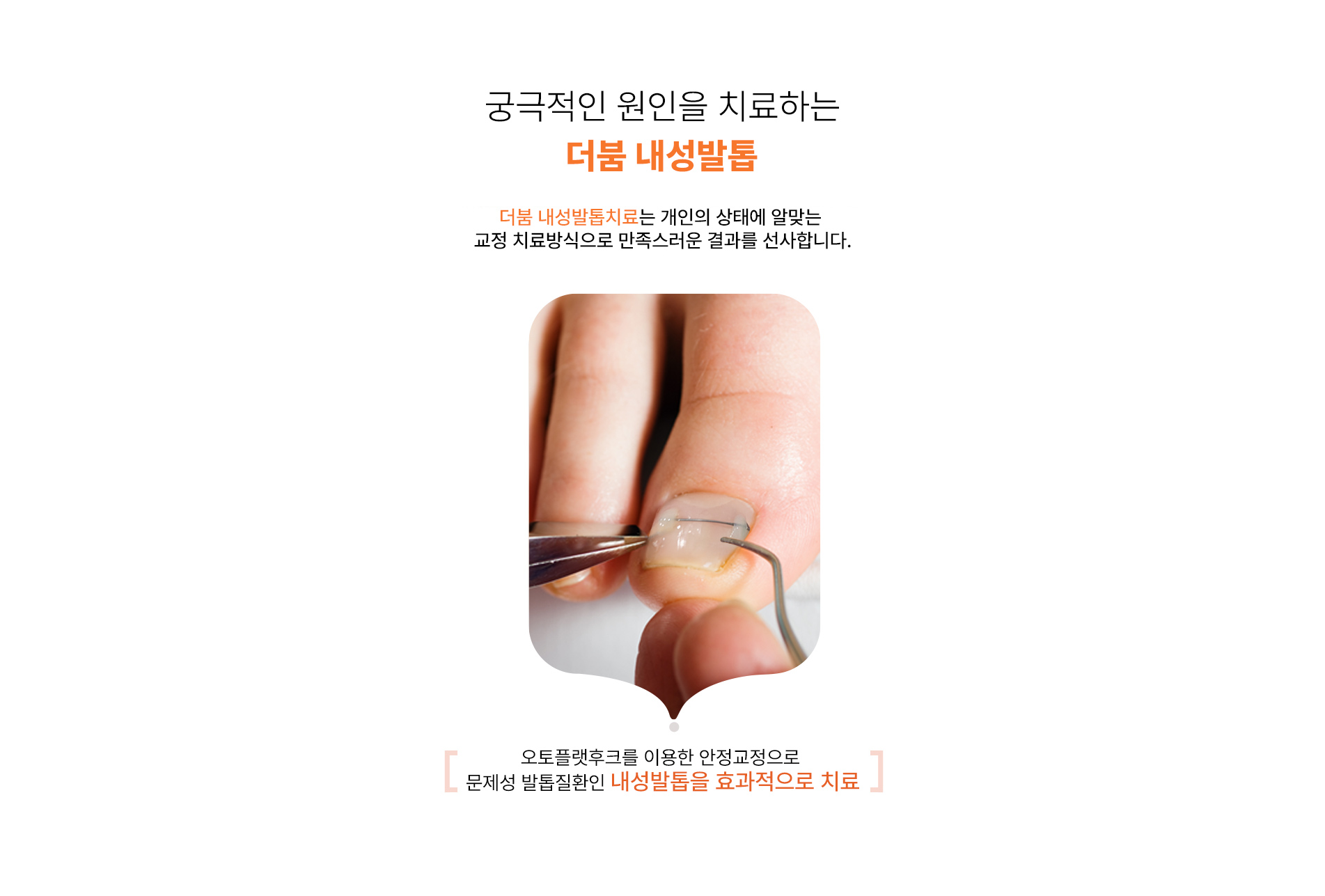 더붐 내성발톱치료