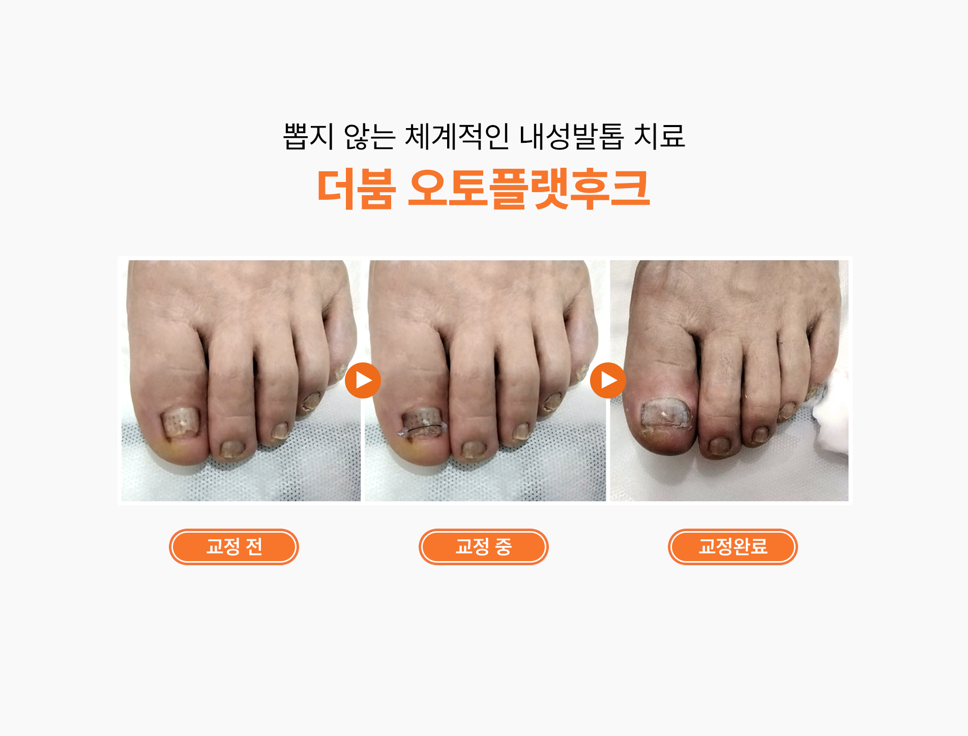 더붐 내성발톱치료